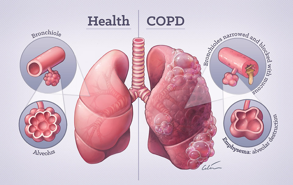 Healthy+vs+COPD+lungs+960px
