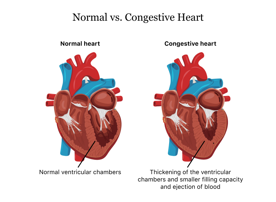 Normal-vs.-Congestive-Heart